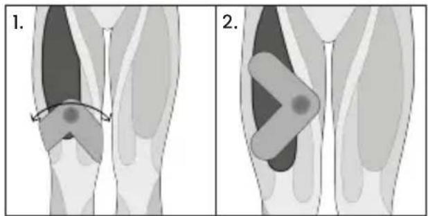 TensCare Form - Tríceps - 12