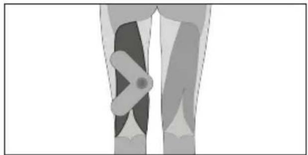 TensCare Form - Triceps - 9