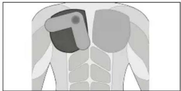 TensCare Form - Triceps - 3