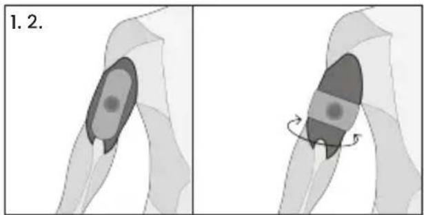 TensCare Form - Tríceps - 1