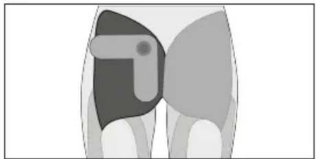 TensCare Form - Tríceps - 20