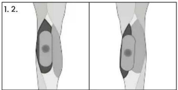 TensCare Form - Tríceps - 6