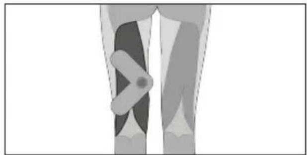 TensCare Form - Tríceps - 9