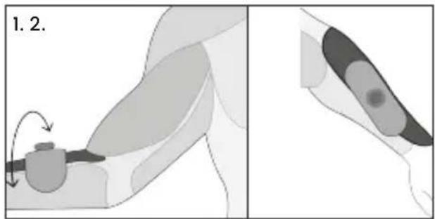 TensCare Form - Triceps - 2