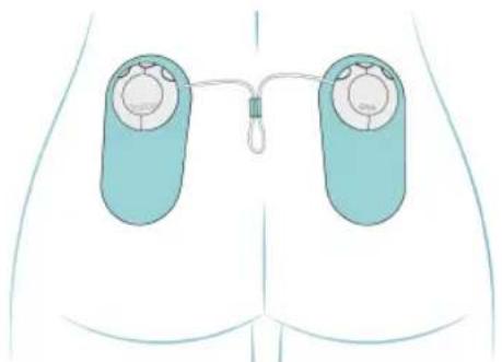 TensCare Ova 3 - Application des électrodes - 4