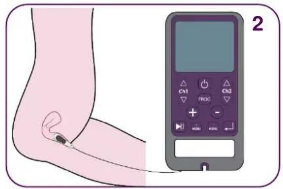 TensCare Sure PRO - 10) PAIN – Pelvic pain - 2