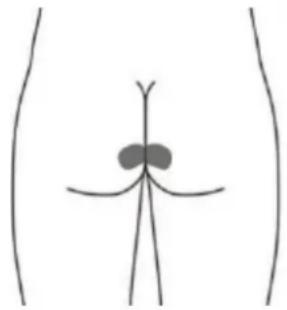 TensCare Sure PRO - Optional skin surface electrode placement for URGE (this may not be as effective as the stimulation with the vaginal probe) - 3