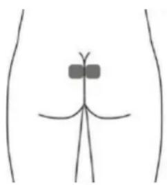 TensCare Sure PRO - Optional skin surface electrode placement for URGE (this may not be as effective as the stimulation with the vaginal probe) - 2
