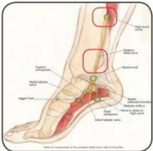 TensCare Sure PRO - TRANSCUTANEOUS TIBIAL NERVE STIMULATION - 3