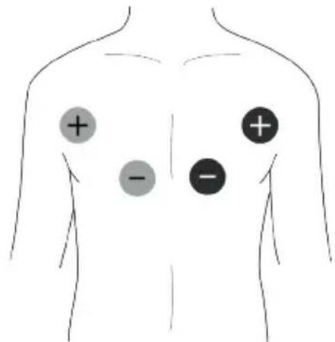 TensCare Unipro - Placement des électrodes EMS - 1