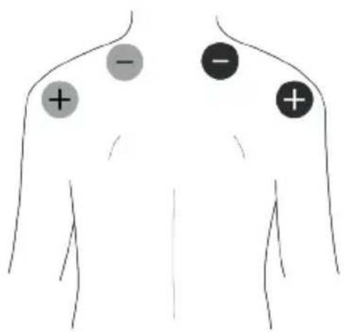 TensCare Unipro - EMS Pad Placement - 6