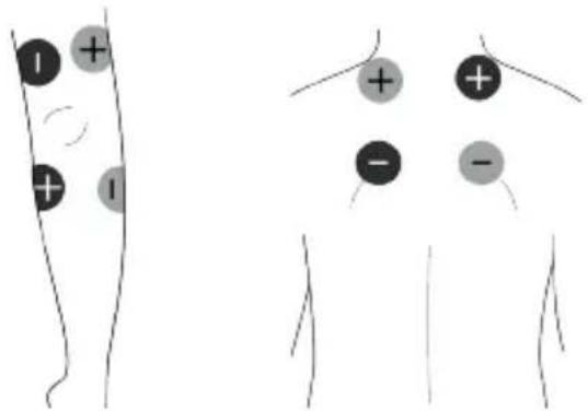 TensCare Unipro - Placementdesélectrodes IFT4 - 2