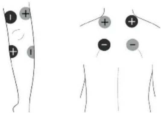 TensCare Unipro - IFT4-Pad Platzierung - 2