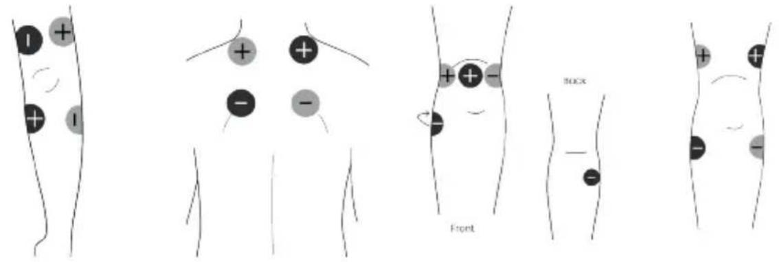 TensCare Unipro - IFT4 Pad Placement - 2