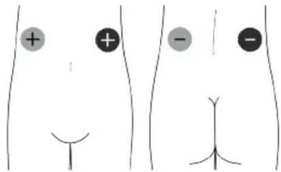 TensCare Unipro - Colocación de los electrodos IFT4 - 4