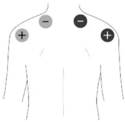 TensCare Unifit - EMS Pad Placement - 3