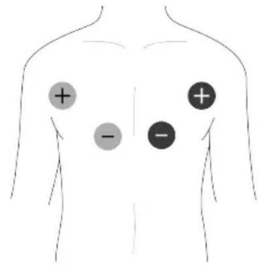 TensCare Unifit - EMS Pad Placement - 2