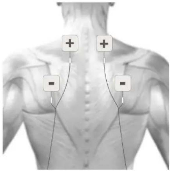 TensCare Sports TENS 2 - MASSAGE ELECTRODE PLACEMENT - 1