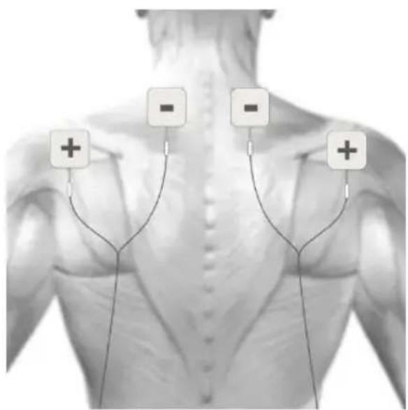 TensCare Sports TENS 2 - MASSAGE- ELEKTRODENPLATZIERUNG - 1