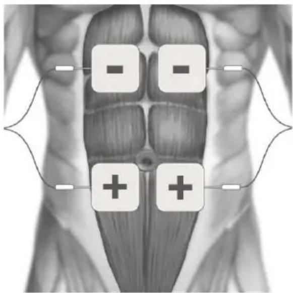 TensCare Sports TENS 2 - TENS ELECTRODE PLACEMENT - 5
