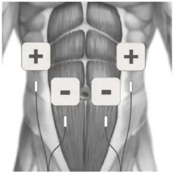 TensCare Sports TENS 2 - EMS ELECTRODE PLACEMENT - 5