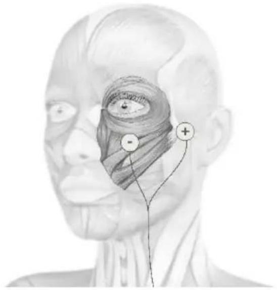 TensCare Sports TENS 2 - Face treatment with optional electrode pads - 2