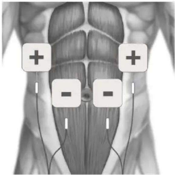 TensCare Sports TENS 2 - TENS ELECTRODE PLACEMENT - 4