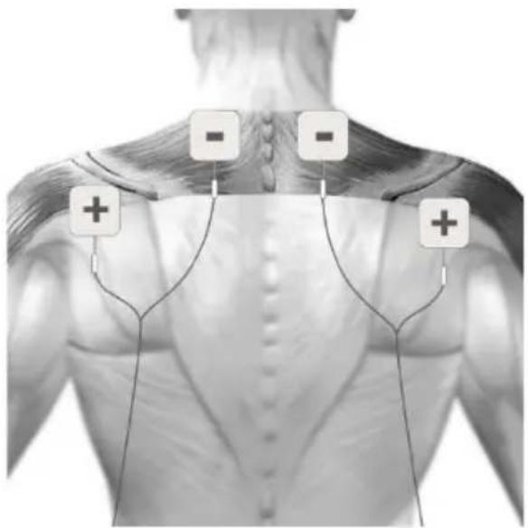 TensCare Sports TENS 2 - TENS ELECTRODE PLACEMENT - 3