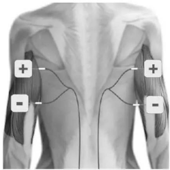 TensCare Sports TENS 2 - TENS ELECTRODE PLACEMENT - 1