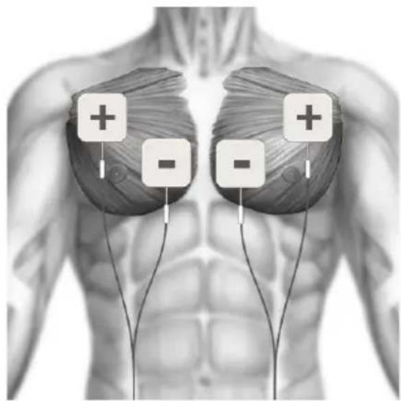 TensCare Sports TENS 2 - PLACEMENT DES ÉLECTRODES EMS - 2