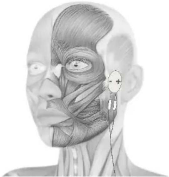 TensCare Sports TENS 2 - Face treatment with optional electrode pads - 4
