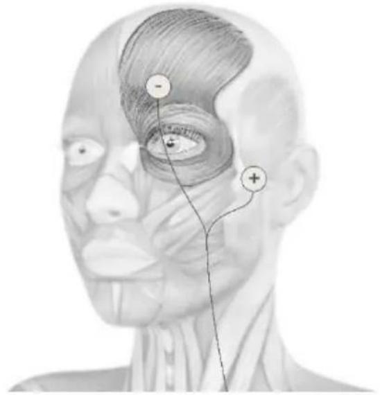TensCare Sports TENS 2 - Face treatment with optional electrode pads - 1