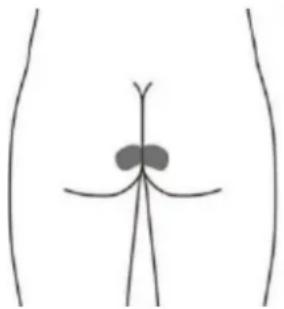 TensCare iTouch Sure - Optional skin surface electrode placement for URGE (this may not be as effective as the stimulation with the vaginal probe) - 3