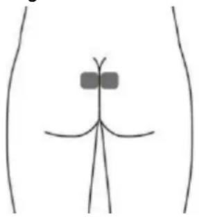 TensCare iTouch Sure - Optionale Elektroden für DRANG (URGE) (dies ist möglicherweise nicht so effektiv wie die Stimulation mit der Vaginalsonde). - 1