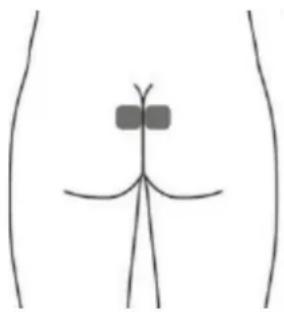 TensCare iTouch Sure - Optional skin surface electrode placement for URGE (this may not be as effective as the stimulation with the vaginal probe) - 1