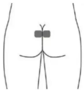 TensCare iTouch Sure - Positionnement des électrodes auto-adhésives en option pour URGE (peut être moins efficace que la stimulation avec la sonde vaginale) - 1