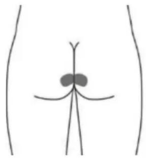 TensCare Unicare - Optional skin surface electrode placement for URGE (this may not be as effective as the stimulation with the vaginal probe) - 2