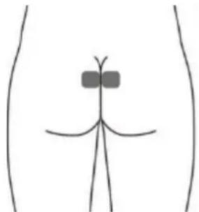 TensCare Unicare - Optional skin surface electrode placement for URGE (this may not be as effective as the stimulation with the vaginal probe) - 1