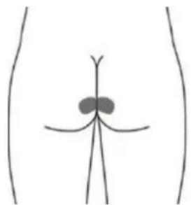 TensCare Unicare - Optionale Elektroden für DRANG (URGE) (dies ist möglicherweise nicht so effektiv wie die Stimulation mit der Vaginalsonde). - 1
