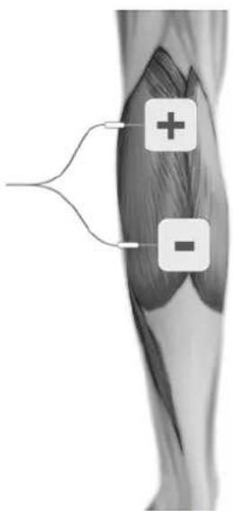 TensCare Allura - ELECTRODE PLACEMENT - 13
