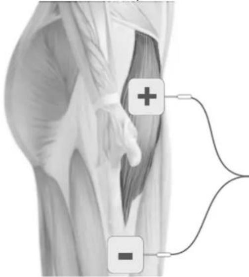 TensCare Allura - ELECTRODE PLACEMENT - 8