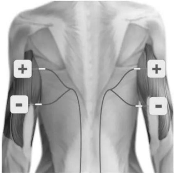 TensCare Allura - POSITIONNEMENT DES ELECTRODES - 9
