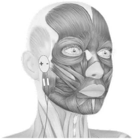 TensCare Allura - ELECTRODE PLACEMENT - 3