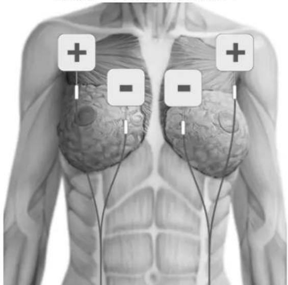 TensCare Allura - POSITIONNEMENT DES ELECTRODES - 7