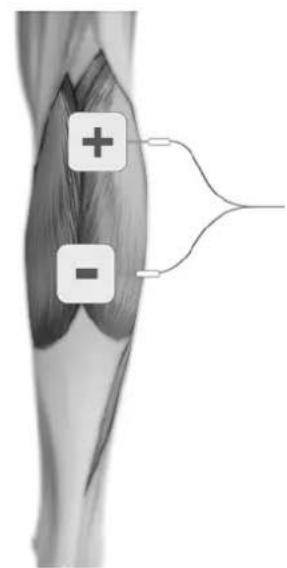 TensCare Allura - ELECTRODE PLACEMENT - 14