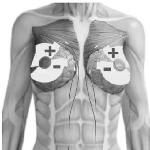 TensCare Eva - ELECTRODE PLACEMENT - 13