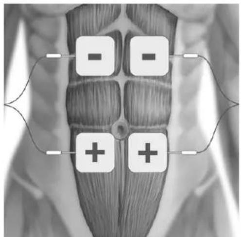 TensCare Eva - POSITIONNEMENT DES ELECTRODES - 5