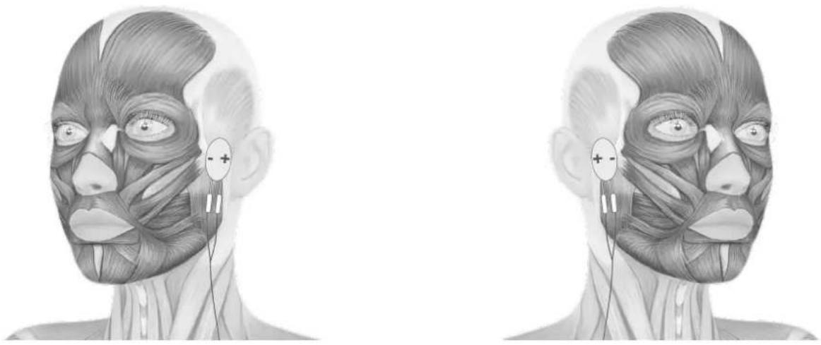 TensCare Eva - ELEKTRODEN PLAZIERUNG - 2
