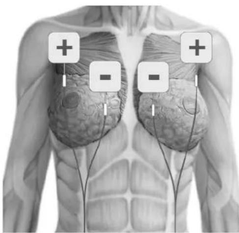 TensCare Eva - ELEKTRODEN PLAZIERUNG - 10