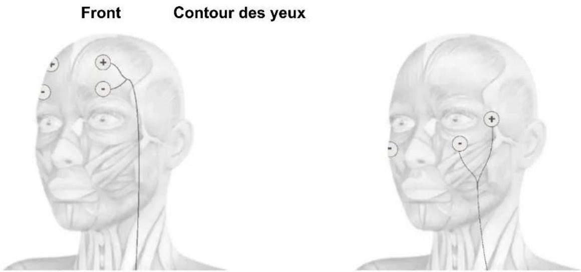 TensCare Eva - POSITIONNEMENT DES ELECTRODES - 3